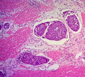 Ảnh 7 Tế bào học UTBM bóng Vater xâm nhập mạch máu Mã số ST0449 nhuộm H E x 100 12