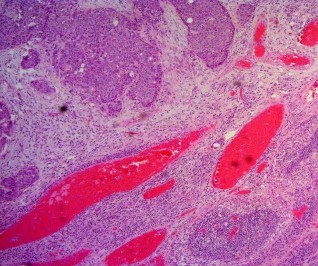 Ảnh 7 Tế bào học UTBM bóng Vater xâm nhập mạch máu Mã số ST0449 nhuộm H E x 100 13