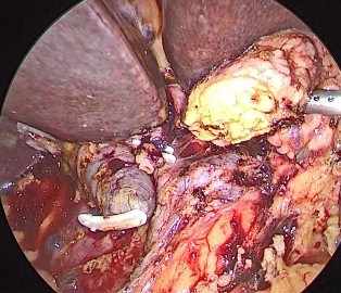 Ảnh 1 Mỏm tụy và ống mật chủ Ảnh 6 Vết mổ sau 12 tháng Ảnh 7 Tế bào học 14