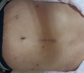 Ảnh 1 Mỏm tụy và ống mật chủ Ảnh 6 Vết mổ sau 12 tháng Ảnh 7 Tế bào học 15