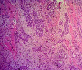 Ảnh 7 Tế bào học UTBMT bóng Vater Mã số ST6682 nhuộm H E x 50 Ảnh 8 Tế bào học 16