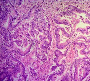 Ảnh 7 Tế bào học UTBMT bóng Vater Mã số ST6682 nhuộm H E x 50 Ảnh 8 Tế bào học 17