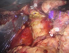 Ảnh 3 S au cắt rời khối tá tụy Ảnh 4 Nối tụy – ruột kiểu Blumgart Ảnh 5 2