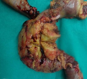 Ảnh 5 Bệnh phẩm khối tá tụy Ảnh 6 Tế bào học UTBMT ống tụy Mã số SR0125 3