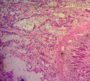 Ảnh 5 Bệnh phẩm khối tá tụy Ảnh 6 Tế bào học UTBMT ống tụy Mã số SR0125 4