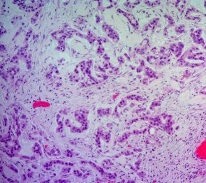 Ảnh 7 Tế bào học UTBMT ống tụy Mã số SR0125 nhuộm H E x 100 Ảnh 8 Tế bào học 5