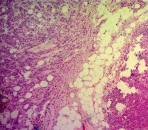 Ảnh 7 Tế bào học UTBMT ống tụy Mã số SR0125 nhuộm H E x 100 Ảnh 8 Tế bào học 6