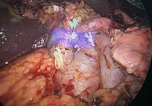 Ảnh 1 Hình ảnh CLVT trước mổ Ảnh 2 Sau cắt rời khối tá tụy Ảnh 4 Thoát vị 7