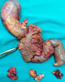 Ảnh 4 Thoát vị túi thừa Meckel qua chân Trocar Mổ lại ngày thứ 7 Ảnh 3 Bệnh 8