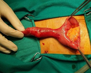 Ảnh 4 Thoát vị túi thừa Meckel qua chân Trocar Mổ lại ngày thứ 7 Ảnh 3 Bệnh 9