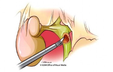 Hình 1 9 Cắt đường mật Nguồn Lillemoe K D 2013 55 Cắt eo tụy sau khi đã phẫu 5