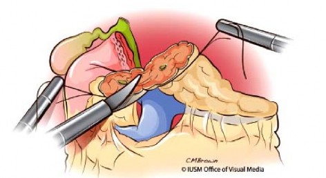 Hình 1 10 Cắt ống tụy bằng kéo Nguồn Lillemoe K D 2013 55 Thủ thuật Kocher và 6