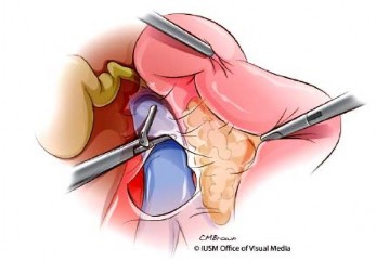 Hình 1 11 Thủ thuật Kocher Nguồn Lillemoe K D 2013 55 Cắt đầu tụy và mỏm móc 7