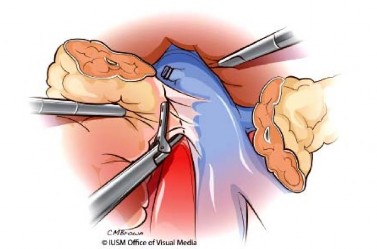 Hình 1 12 Cắt mỏm móc và mạc treo tụy Nguồn Lillemoe K D 2013 55 Nạo vét hạch 8