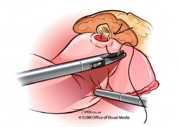 Hình 1 13 Nối tụy – ruột non tận bên Nguồn Lillemoe K D 2013 55 Thì cắt rời 9