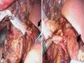 Kỹ Thuật Nâng Đầu Tụy “Pancreas Hanging Maneuver” Nguồn: Kuroki (2010) [87]
