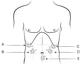 Hình 2 1 Vị trí đặt các trocar và đường mở nhỏ Nguồn Mendoza 2014 97 Bước 2 2
