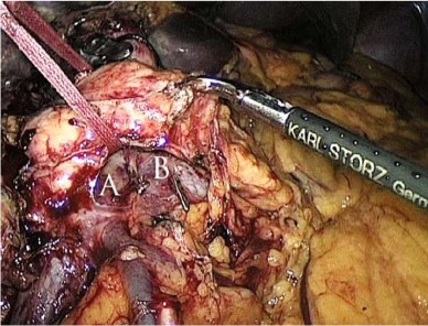 Hình 2 2 Tạo đường hầm sau eo tụy và phức hợp TM mạc treo tràng trên Nguồn 3