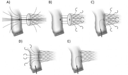Hình 2 4 Miệng nối Kakita A và nối Blumgart cải tiến B C D E Nguồn Tsutomu Fujii 2014 4