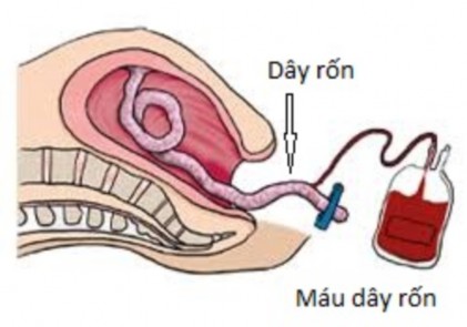 Hình 1 5 Thu thập máu dây rốn trước sổ rau 1 2 1 2 Xử lý máu dây rốn Mẫu MDR 1
