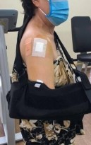 Hình 2 28 Minh họa bất động sau mổ RCX Nguồn ảnh chụp trong mổ của BN Lê Thị 10