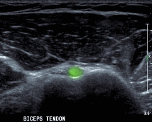 Hình 2 29 Hình ảnh siêu âm khảo sát cơ nhị đầu112 Siêu âm gân cơ dưới vai Tư 12