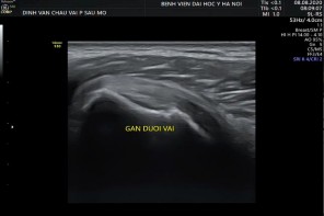 Hình 2 30 Hình ảnh siêu âm khảo sát cơ dưới vai Nguồn ảnh chụp trong mổ của 14