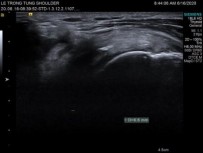 Hình 2 31 Hình ảnh siêu âm khảo sát cơ trên gai Nguồn ảnh chụp trong mổ của BN 16