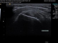 Hình 2 31 Hình ảnh siêu âm khảo sát cơ trên gai Nguồn ảnh chụp trong mổ của BN 18