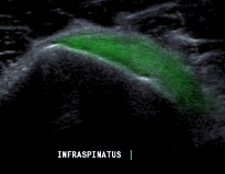 Hình 2 32 Hình ảnh siêu âm khảo sát cơ dưới gai112 Protocol CHT Sử dụng máy CHT 20
