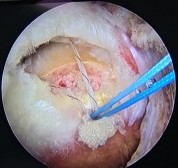 Hình 2 24 Trình tự khâu gân theo phương pháp Mason Allencải biên Nguồn ảnh chụp 3