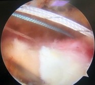 Hình 2 24 Trình tự khâu gân theo phương pháp Mason Allencải biên Nguồn ảnh chụp 4