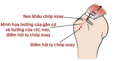 Hình 2 25 Hình vẽ minh hoạ mối liên quan hướng lực kéo gân và điểm hội tụ 5