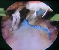 Hình 2 26 Buộc mũi chỉ dọc sau khi buộc mũi chỉ nằm ngang và hình ảnh sau buộc 6