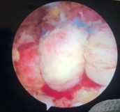 Hình 2 26 Buộc mũi chỉ dọc sau khi buộc mũi chỉ nằm ngang và hình ảnh sau buộc 7