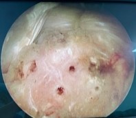 Hình 2 27 Tạo vi tổn thương sau khi buộc chỉ khâu CX Nguồn ảnh chụp trong mổ 8