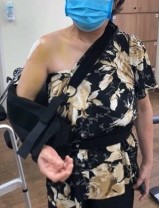 Hình 2 28 Minh họa bất động sau mổ RCX Nguồn ảnh chụp trong mổ của BN Lê Thị 9