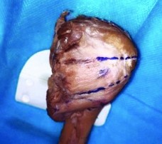 Hình 3 1 Minh hoạ điểm hội tụ CX trên ảnh chụp và trên 3D Nguồn Ảnh phẫu 1