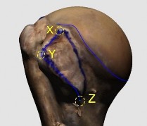 Hình 3 7 Minh hoạ diện bám gân dưới vai hình dấu phẩy Điểm X là điểm trên 11