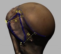 Hình 3 8 Minh hoạ cách đo các KC từ các điểm mốc của diện bám gân dưới vai 12