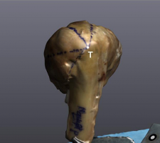 Hình 3 1 Minh hoạ điểm hội tụ CX trên ảnh chụp và trên 3D Nguồn Ảnh phẫu 2