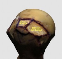 Hình 3 2 Hình ảnh diện bám gân trên gai dưới gai tròn bé Nguồn Ảnh phẫu tích 3