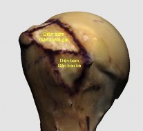 Hình 3 2 Hình ảnh diện bám gân trên gai dưới gai tròn bé Nguồn Ảnh phẫu tích 4