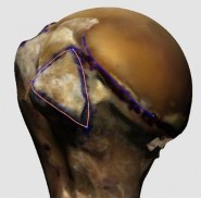 Hình 3 5 Minh hoạ diện bám gân dưới vai hình dấu phẩy hình bầu dục và hình 8