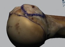 Hình 3 6 Minh hoạ bờ ngoài diện bám gân dưới vai ở phía trên và phía dưới 9