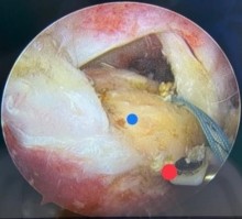 Hình 4 1 Hình ảnh minh hoạ vị trí dự kiến đặt neo tiếp theo điểm màu tròn 1