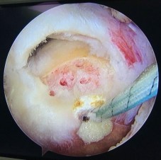 Hình 4 3 Hình ảnh lỗ vi tổn thương ở hàng đầu tiên phía trong vị trí đặt 3