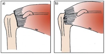 Hình 4 5 Minh hoạ vị trí đặt hai neo khâu trong trường hợp đứt hoàn toàn gân 1