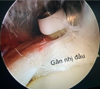 Hình 4 6 Ảnh minh hoạ tổn thương gân nhị đầu 30 gân và hình ảnh sau cắt gân 2