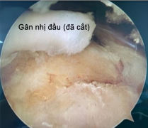 Hình 4 6 Ảnh minh hoạ tổn thương gân nhị đầu 30 gân và hình ảnh sau cắt gân 3